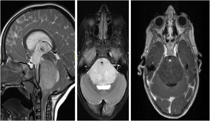 brain mri scan tumor