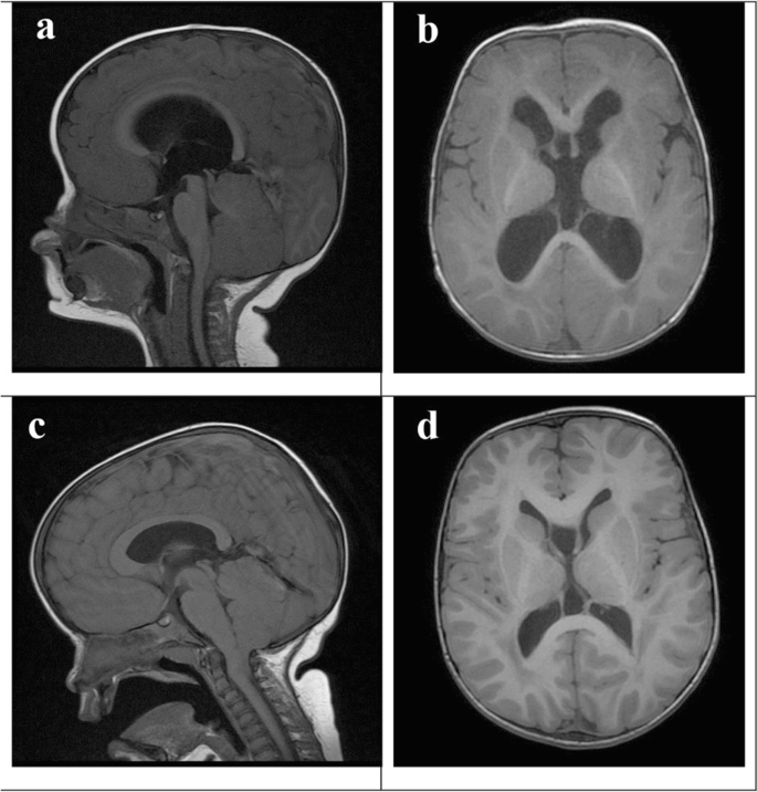 Megalencephaly Capillary Malformation Syndrome And Associated Hydrocephalus Treatment Options And Revision Of The Literature Springerlink
