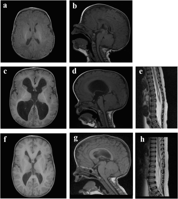 Megalencephaly Capillary Malformation Syndrome And Associated Hydrocephalus Treatment Options And Revision Of The Literature Springerlink