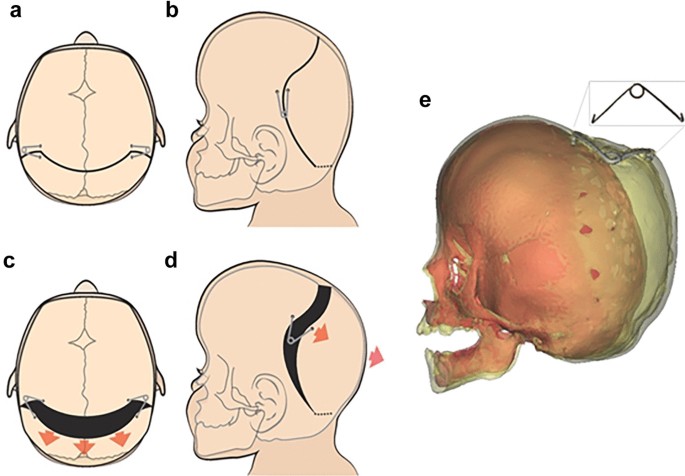 Spring-assisted posterior vault expansion—a single-centre experience of 200  cases | Child's Nervous System