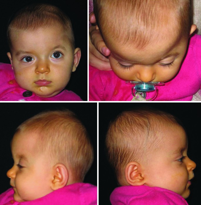 Long-term aesthetic and photogrammetric outcomes in non-syndromic unicoronal synostosis: comparison of fronto-orbital distraction osteogenesis and fronto-orbital advancement and remodeling | Child's Nervous System