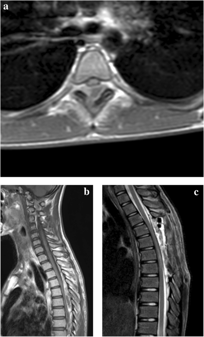 Spinal epidural abscess in an adolescent male: an unusual etiology and ...