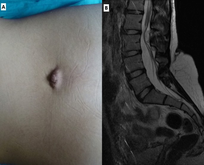 The human tail: a case series of five patients and a review of the ...