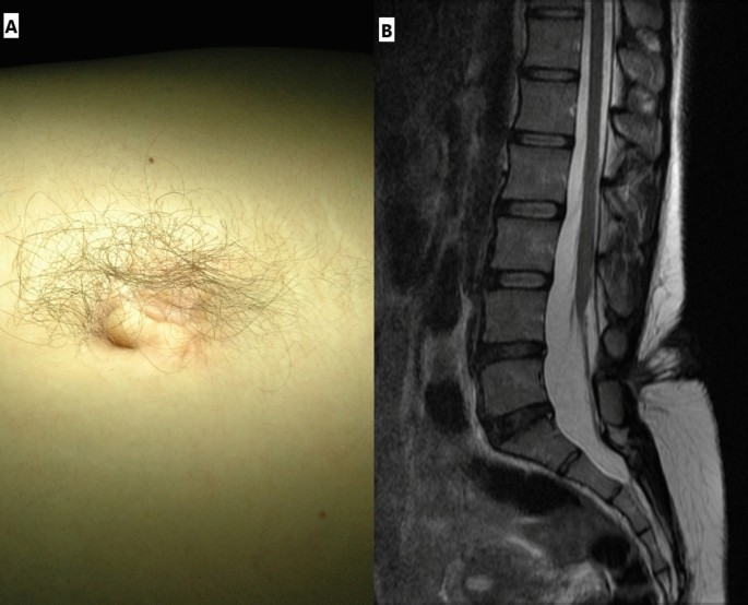 The human tail: a case series of five patients and a review of the ...