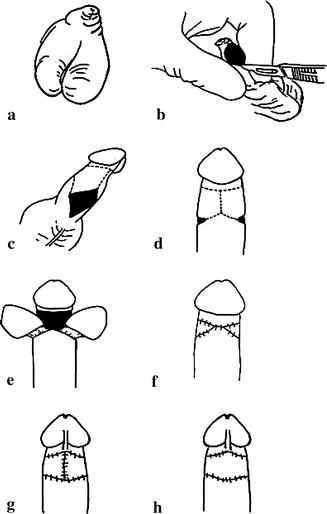 Preputial flaps to correct buried penis | SpringerLink