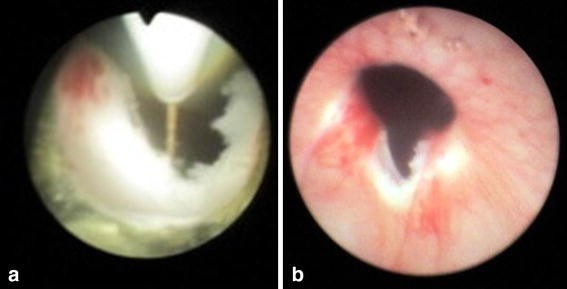 Bladder Neck Incision (B.N.I.) and Urethrotomy