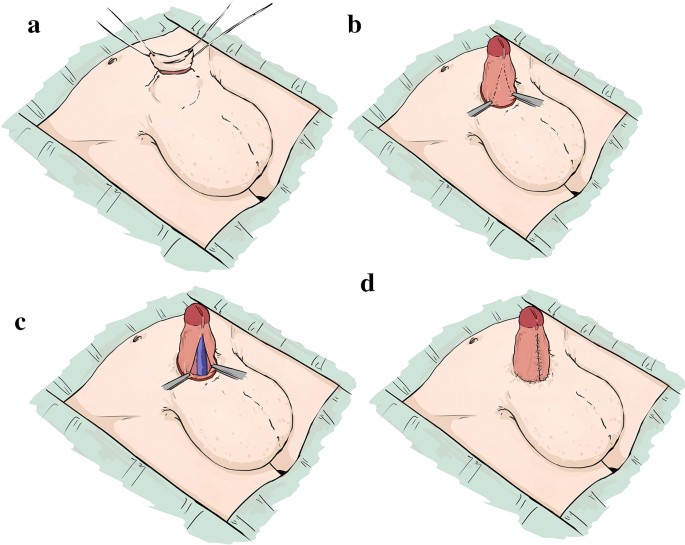 a–b Foreskin retraction in CMP. a Foreskin retraction reveals