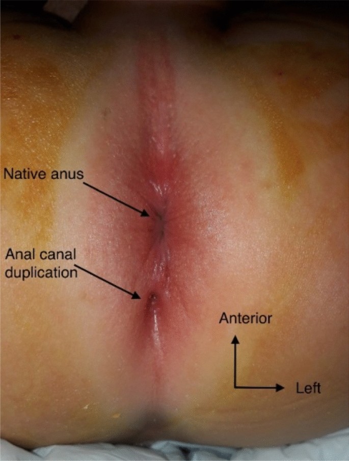 anal