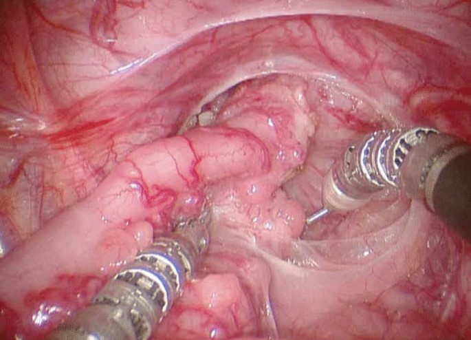 Case 52-1991 — An Eight-Year-Old Girl with Recurrent Abdominal Distention  after Surgical Correction of Hirschsprung's Disease