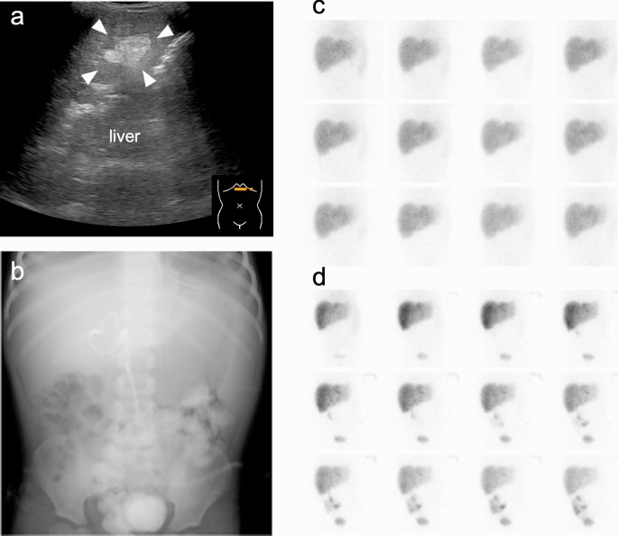 Role of percutaneous transhepatic biliary drainage for managing bile