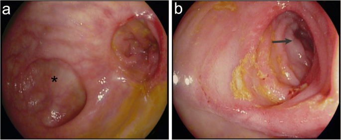 Enterocutaneous fistula in severely active Crohn's disease: preoperative  anti-TNF alpha treatment to limit bowel resection—report of a case |  SpringerLink