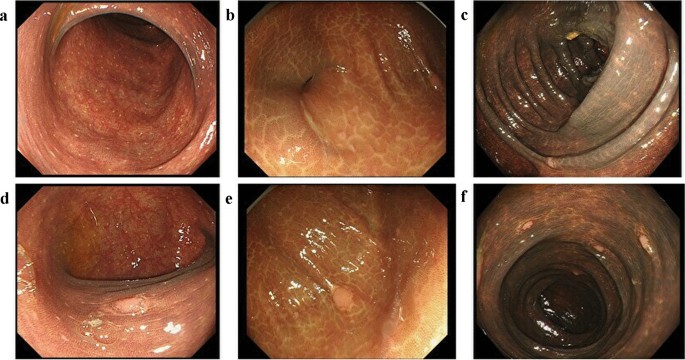 Colorectal neoplasms in melanosis coli: a survey in Japan and a worldwide  meta-analysis | International Journal of Colorectal Disease