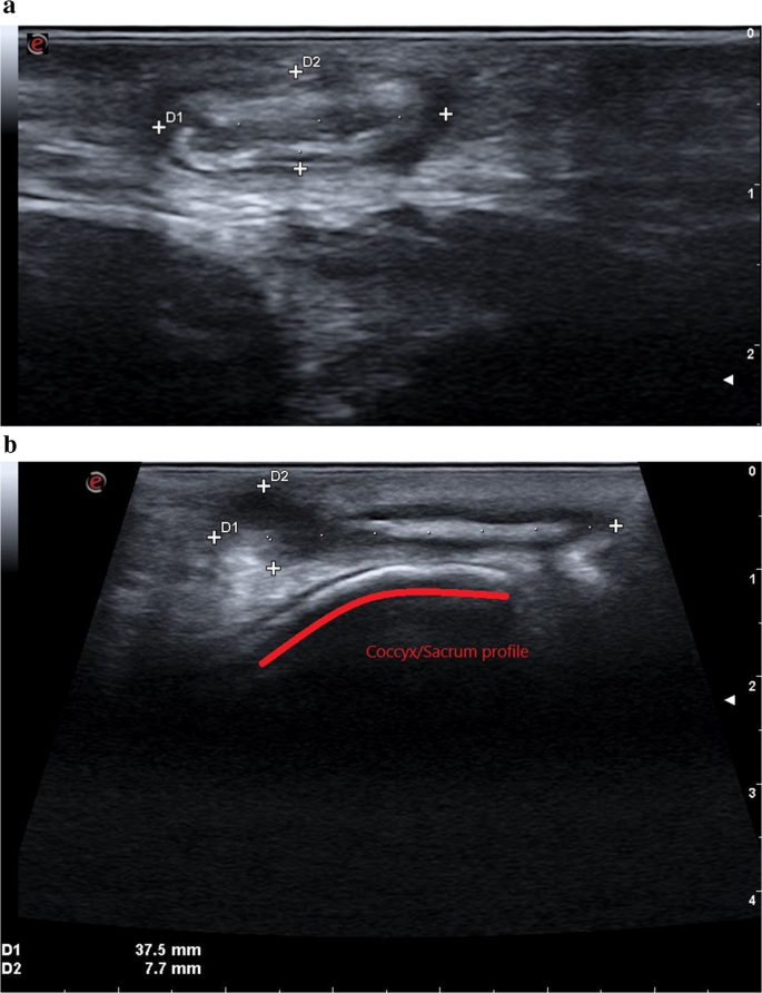 Intra-operative ultrasound in the surgical treatment of complex and ...