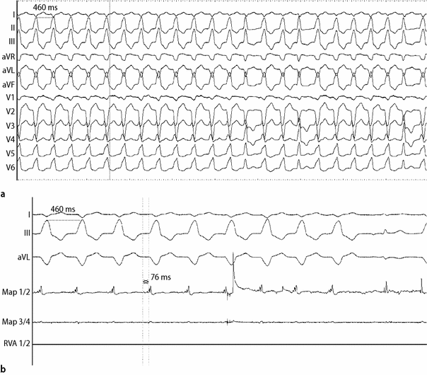 Catheter Ablation Of An Incessant Ventricular Tachycardia Originating From The Left Aortic Sinus Cusp In An Adolescent With Subacute Myocarditis Springerlink