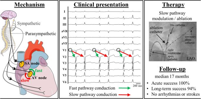 atrioventricular node