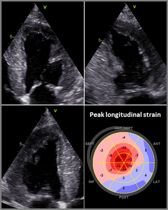 Diagnosis And Treatment Of Cardiac Amyloidosis Position Statement Of The German Cardiac Society Dgk Springerlink