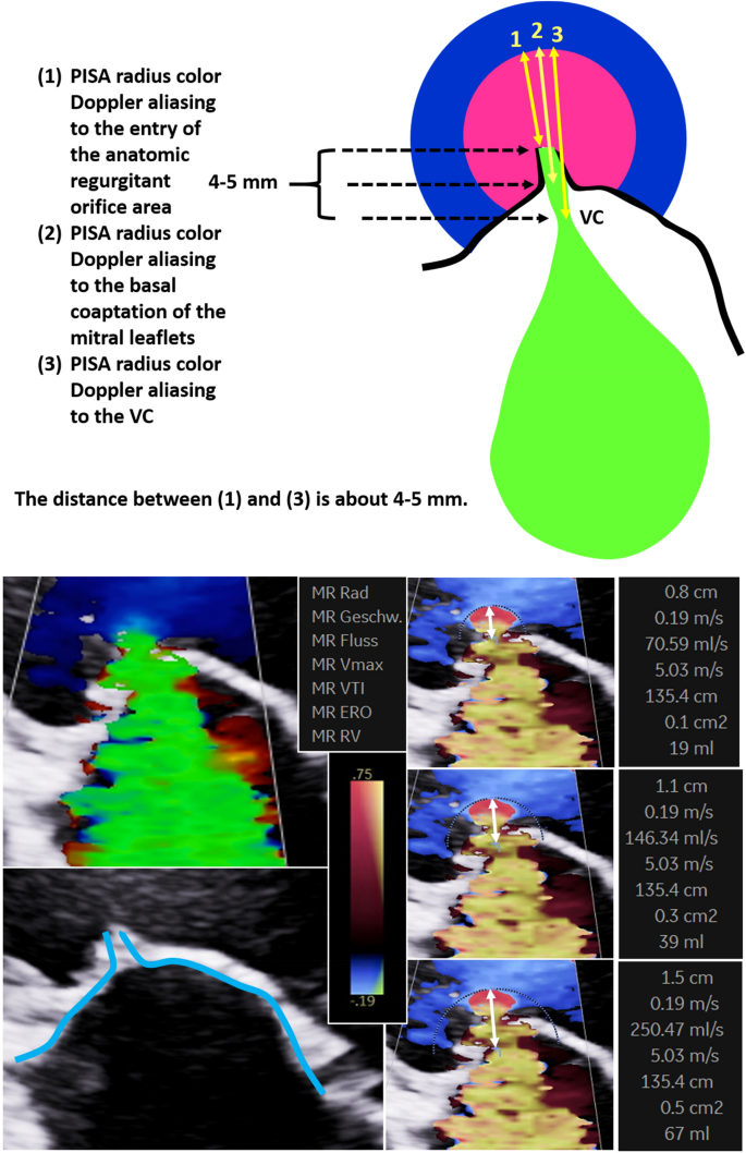 Echocardiographic assessment of mitral regurgitation: discussion of  practical and methodologic aspects of severity quantification to improve  diagnostic conclusiveness | SpringerLink