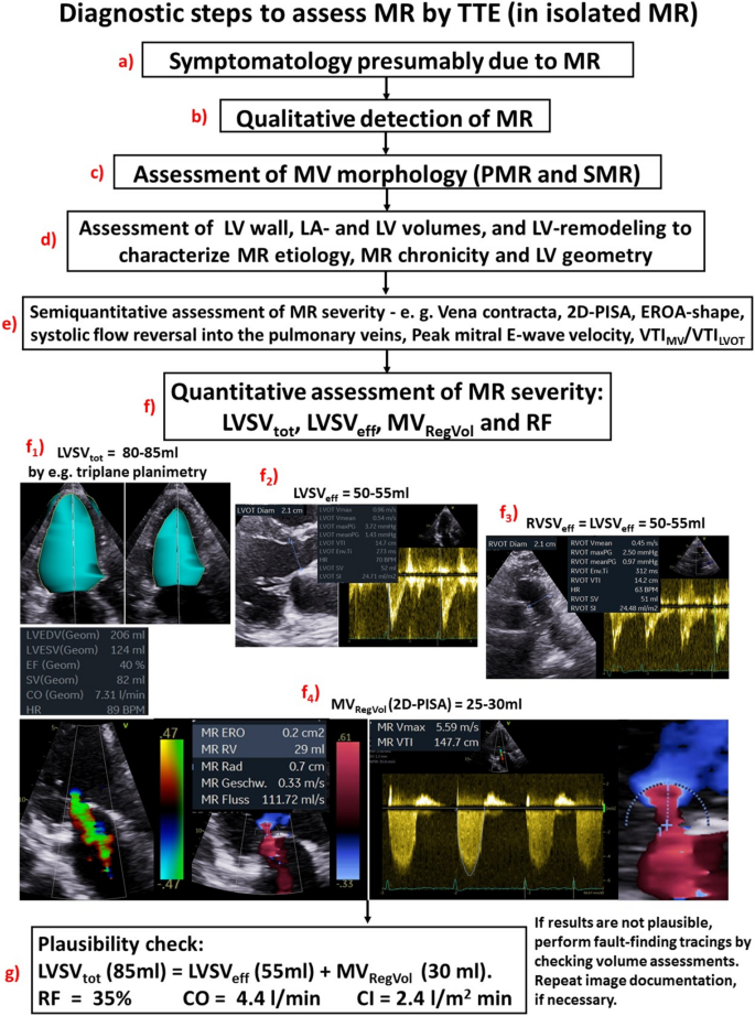 Echocardiographic assessment of mitral regurgitation: discussion of  practical and methodologic aspects of severity quantification to improve  diagnostic conclusiveness | SpringerLink