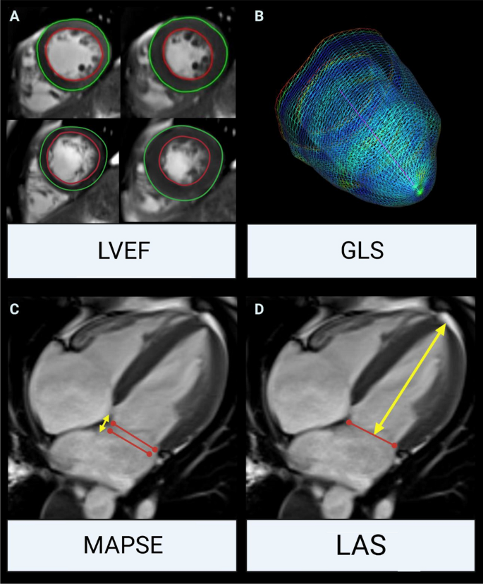 Feature Tracking of Global Longitudinal Strain by Using Cardiovascular MRI  Improves Risk Stratification in Heart Failure with Preserved Ejection  Fraction
