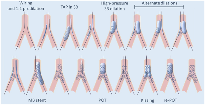 Randomized non-inferiority TrIal comParing reverse T And Protrusion versus  double-kissing and crush Stenting for the treatment of complex left main  bifurcation lesions | SpringerLink