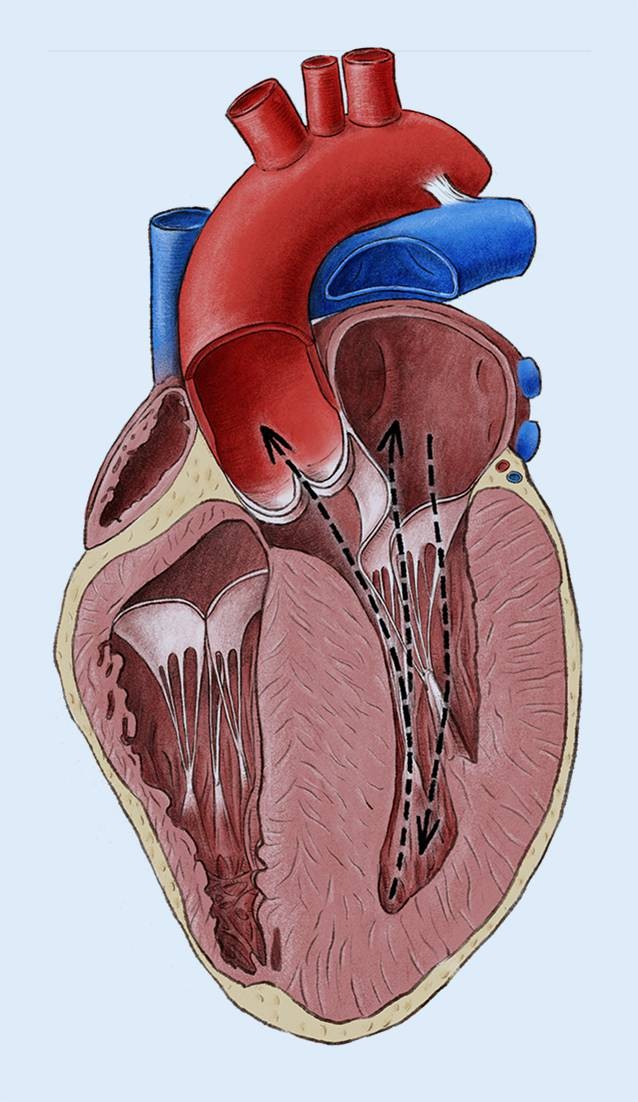 Operative Techniken Bei Hypertropher Obstruktiver Kardiomyopathie Springerlink