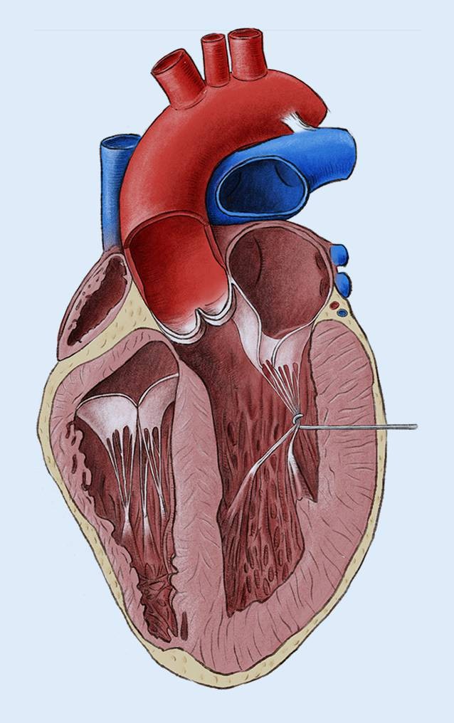 Operative Techniken Bei Hypertropher Obstruktiver Kardiomyopathie Springerlink