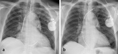 Reel Syndrome In An Icd With Df4 Connector Springerlink