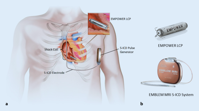 The Modular Cardiac Rhythm Management System The Empower Leadless Pacemaker And The Emblem Subcutaneous Icd Springerlink