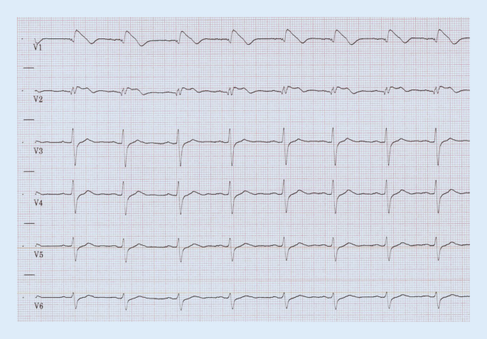 Brugada Syndrom Springerlink