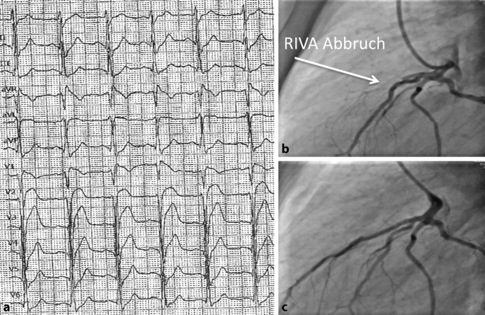Brugada Syndrom Springerlink