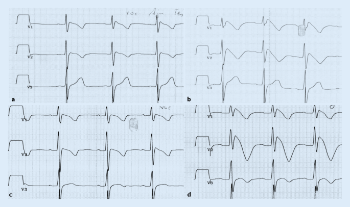 Brugada Syndrom Springerlink