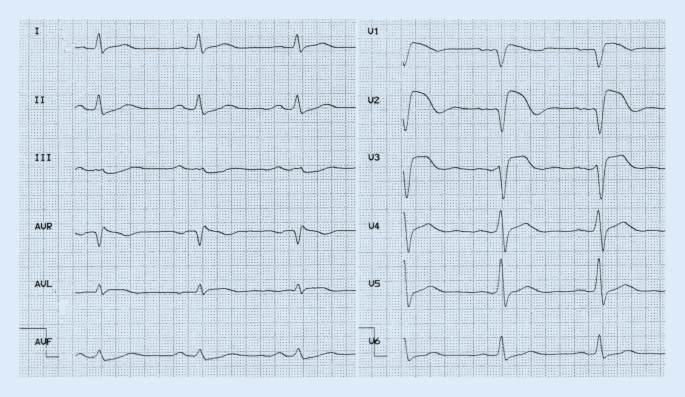 Brugada Syndrom Springerlink