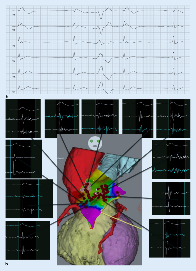 Brugada Syndrom Springerlink