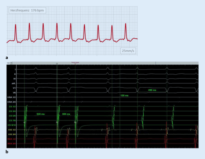Jump-Phänomen zur SVT-Induktion und die Korrelation mit der  EKG-Dokumentation über die Apple Watch™ | SpringerLink