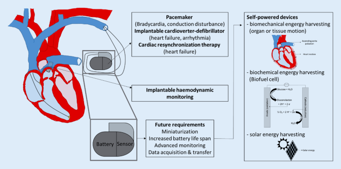 New strategies for energy supply of cardiac implantable devices |  SpringerLink