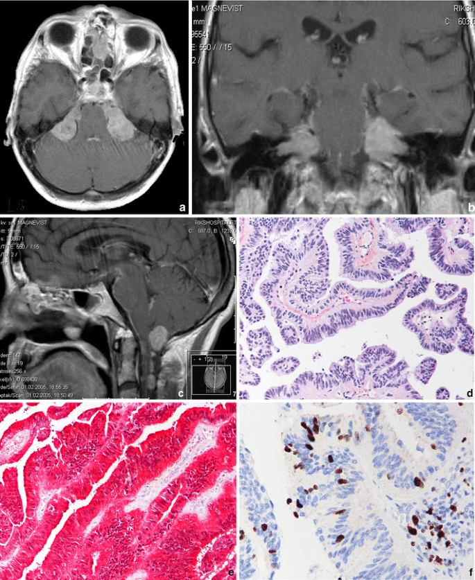 atypical choroid plexus papilloma icd 10