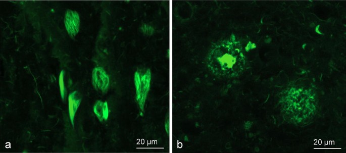 Alzheimer S Disease Clinical Variants Show Distinct Regional Patterns Of Neurofibrillary Tangle Accumulation Springerlink Alzheimer S Disease Clinical Variants Show Distinct Regional Patterns Of Neurofibrillary Tangle Accumulation Springerlink