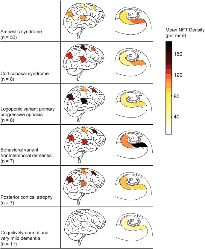 Alzheimer S Disease Clinical Variants Show Distinct Regional Patterns Of Neurofibrillary Tangle Accumulation Springerlink Alzheimer S Disease Clinical Variants Show Distinct Regional Patterns Of Neurofibrillary Tangle Accumulation Springerlink