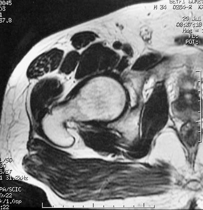 Arthroscopic diagnosis and treatment of an acetabular labrum bucket handle  tear: a case report | SpringerLink
