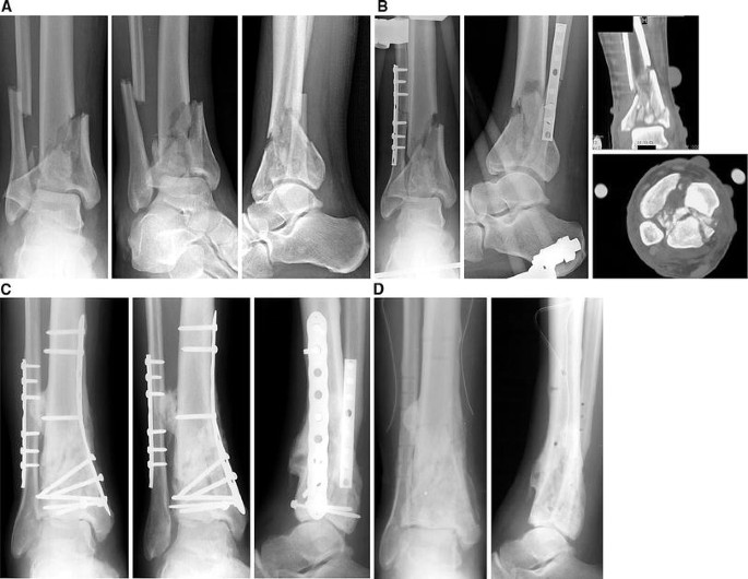Minimally invasive treatment of pilon fractures with a low profile plate:  preliminary results in 17 cases | SpringerLink