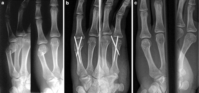 Antegrade intramedullary splinting or percutaneous retrograde crossed  pinning for displaced neck fractures of the fifth metacarpal? | SpringerLink