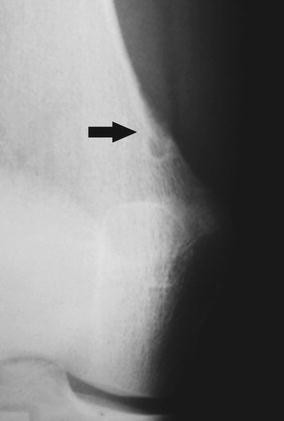Cortical Desmoid And The Four Clinical Scenarios Springerlink