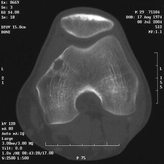 Synovial hemangioma of the knee joint with cystic invasion of the femur: a  case report and review of the literature | SpringerLink