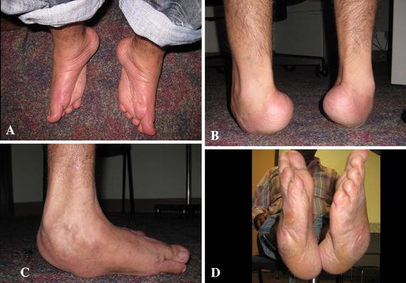 Case Report Correction Of Neglected Club Foot Deformity By Arthroscopic Assisted Triple Arthrodesis Springerlink