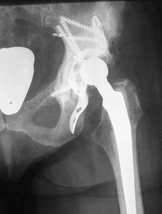 The Burch–Schneider cage for reconstruction after metastatic destruction of  the acetabulum: outcome and complications | SpringerLink