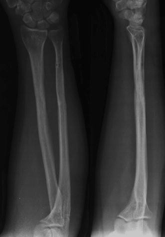 Management of pediatric forearm fractures: what is the best therapeutic  choice? A narrative review of the literature | MUSCULOSKELETAL SURGERY