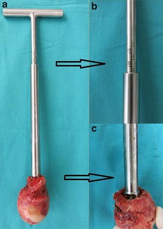 Femoral Head Extractors - Precision Orthopedic Tools