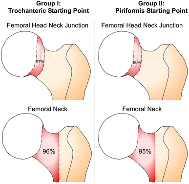 The effect of antegrade femoral nailing on femoral head perfusion: a comparison of piriformis fossa and trochanteric entry points | SpringerLink The effect of antegrade femoral nailing on femoral head perfusion: a comparison of piriformis fossa and trochanteric entry points | SpringerLink