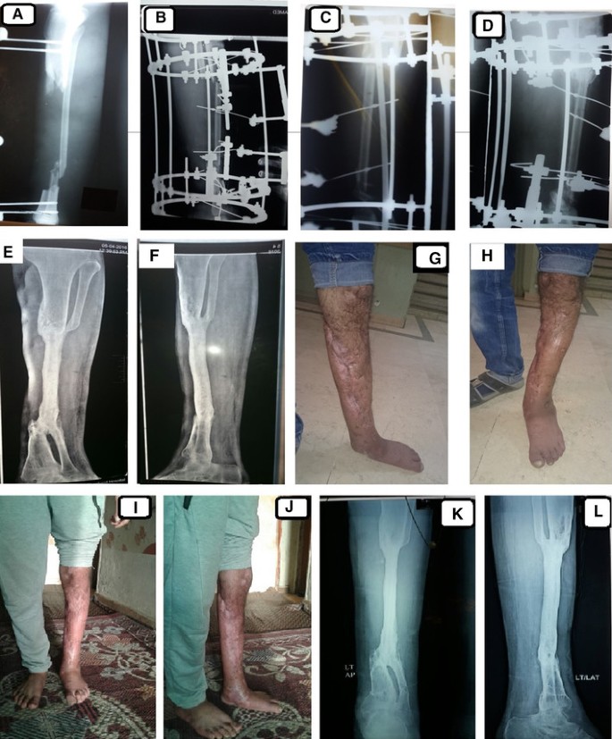 Management of post-traumatic bone defects of the tibia using vascularised  fibular graft combined with Ilizarov external fixator - ScienceDirect