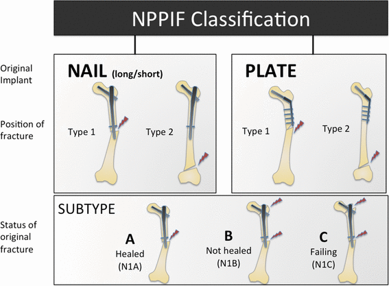 waterfall Choice Various Non-prosthetic peri-implant fractures: classification, management and outcomes | SpringerLink waterfall Choice Various Non-prosthetic peri-implant fractures: classification, management and outcomes | SpringerLink
